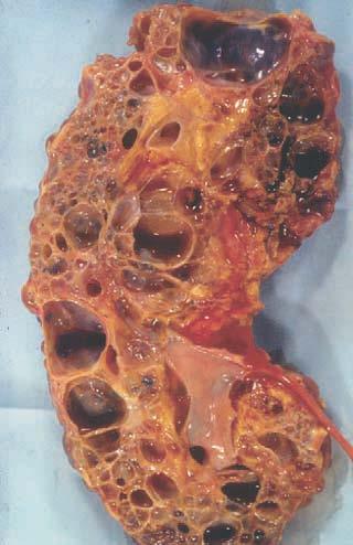 Otozomal Dominant Polikistik Böbrek Hastalığı Ecder T, Fick-Brosnahan GM, Schrier RW: Diseases of the Kidney and Urinary Tract, 2007 En sık görülen kalıtsal böbrek hastalığıdır.