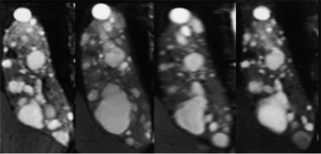 CRISP (The Consortium for Radiologic Imaging Studies of Polycystic Kidney