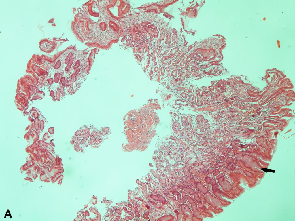 Gastrik lezyonların etyolojisi bilinmemektedir; ancak kronik gastrit, gastrik anastomoz, gastrik kanser, diyabetes mellitus, hiperlipidemi, HP enfeksiyonu ile ilişkisi olabileceği öne sürülmektedir