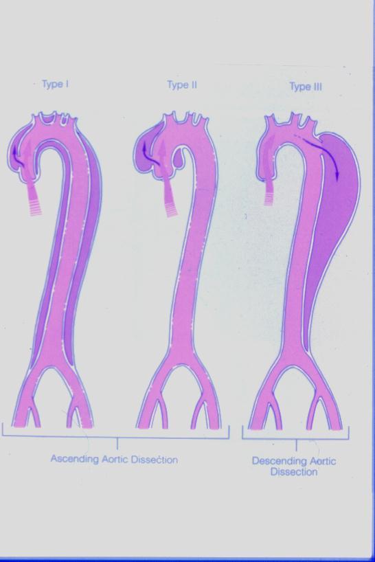 Hipertansiyon: Aort disseksiyonu
