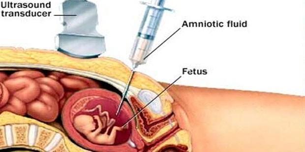 AMNİYOSENTEZ Amniyotik sıvı örneğinin enjektörle ultrason eşliğinde