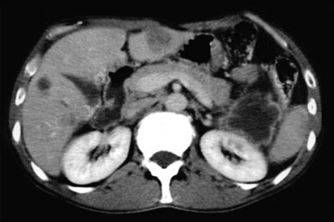 ÖKTEN ve ark. Resim1. Pankreas kuyruk yerleşimli düzensiz s n rl santral hipodens kitle lezyonu ve karaciğer metastazlar Resim 2.