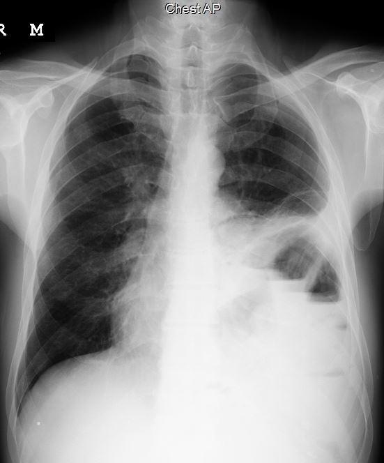 Yirmi bir yaşında erkek hasta aralıklı nefes darlığı şikayeti ile bronkodilatatör ve antibiotik tedavisi görmüş.