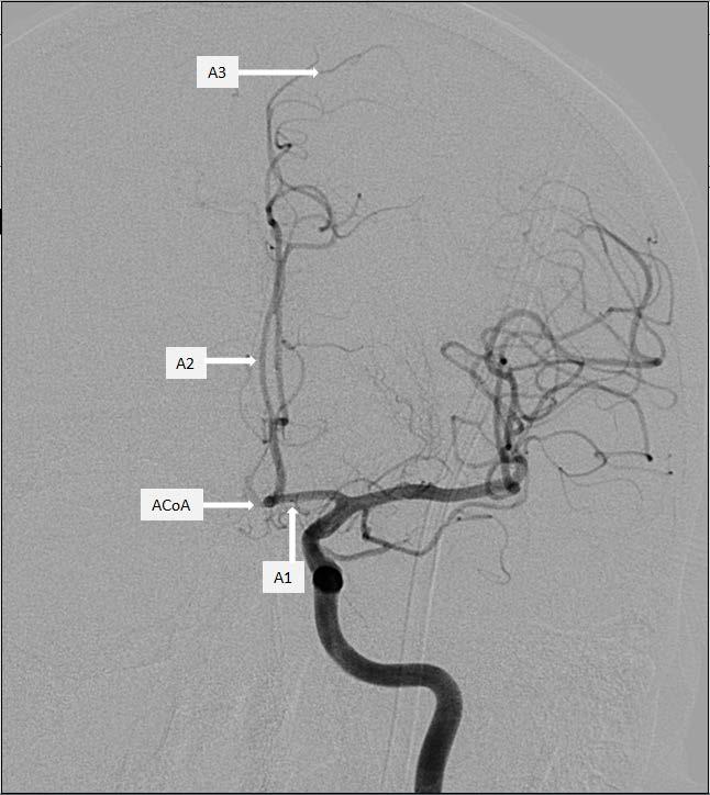 Anterior Serebral Arter (ACA) Anterior serebral arterin ilk horizontal bölümüne A1 segmenti adı verilir. Daha sonra korpus kallozum genusu boyunca yukarıya doğru dönerken A2 segmentini oluşturur.