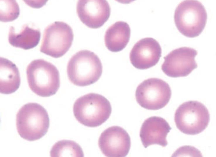 Hemoglobinopatilerde tanısal yaklaşım Hemogram Periferik kan yayması ve retikulosit