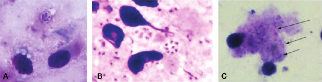 Ataman Hatipoğlu Ç. Resim 5. (A). Kist ve trofozoidler (Giemsa boyası), (B) Akciğer dokusu, kist ve trofozoidler (Giemsa boyası), (C) BAL örneği, trofozoidler (Giemsa). Resim 6.