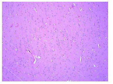 Nodüler heterotopi NF1+Epilepsi+MTS tanısı olan 2