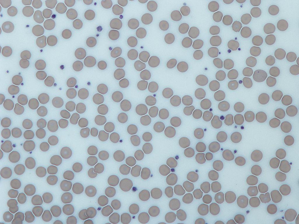 07/04/17 Trombosit, Platelet, Kan Pulcuğu Pıhtılaşmada görevlidir. Hücre parçası gibidir. 150.000 400.000/uL 43 Trombosit - 2 Çekirdeği yoktur, organeller bulundurur.