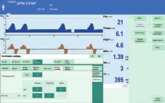 SMARTCARE 21 5. KURALLARI DEĞİŞTİRME Ventilasyondan ayırma protokolünü özelleştirmek için genişletilmiş işlevsellik Bu sayede hasta için bireysel bir solunum konfor alanı tanımlayabilirsiniz.