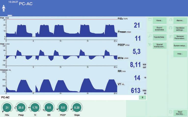 6 PC-BIPAP VE PC-AC PC-AC ile PEEP düzeyinde tespit edilen her solunum denemesi, zorunlu bir mekanik solunumu tetikler.