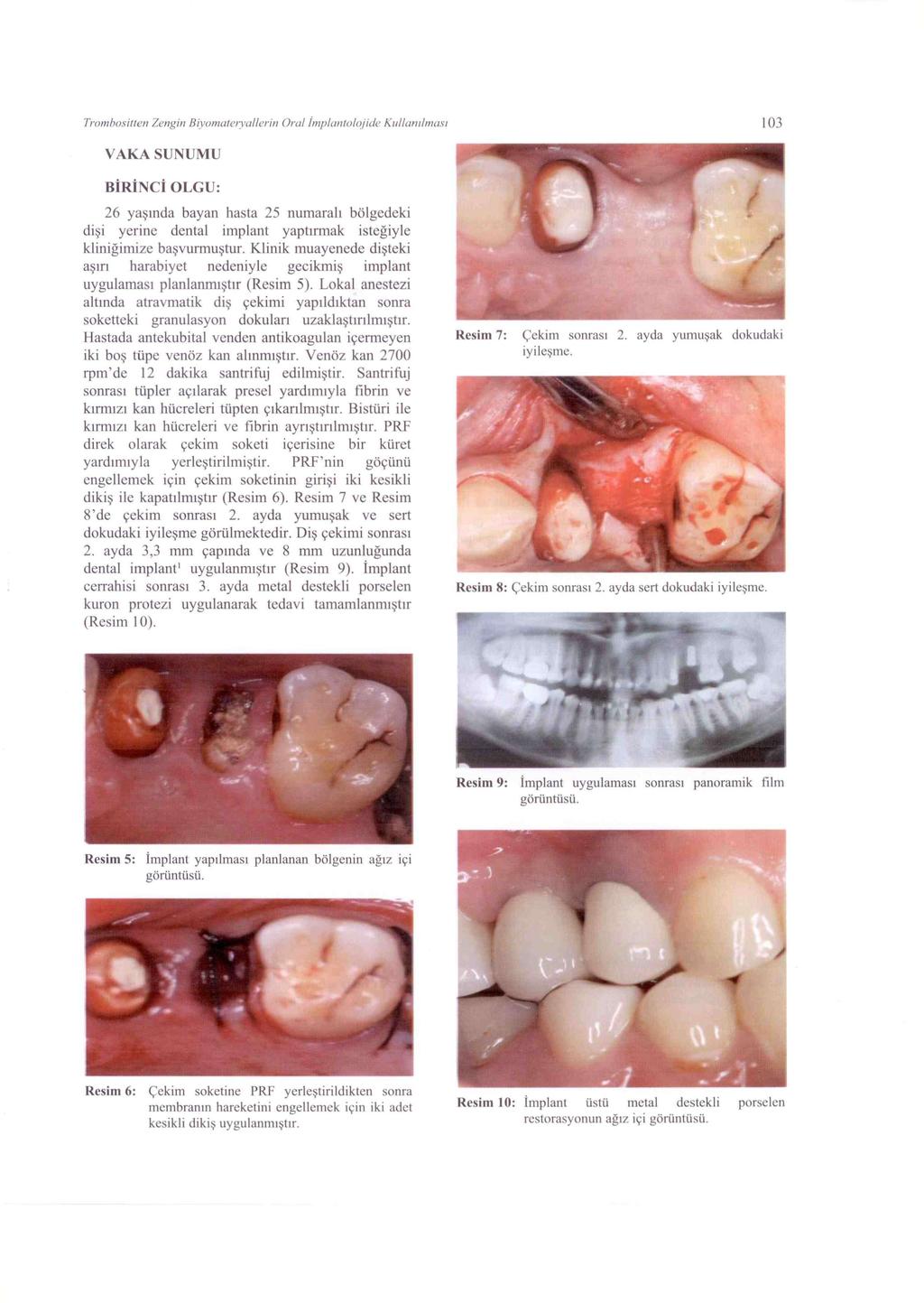 Trombositten Zengin Biyomateryallerin Oral İmplantolojide Kullanılması 103 VAKA SUNUMU BİRİNCİ OLGU: 26 yaşında bayan hasta 25 numaralı bölgedeki dişi yerine dental implant yaptırmak isteğiyle