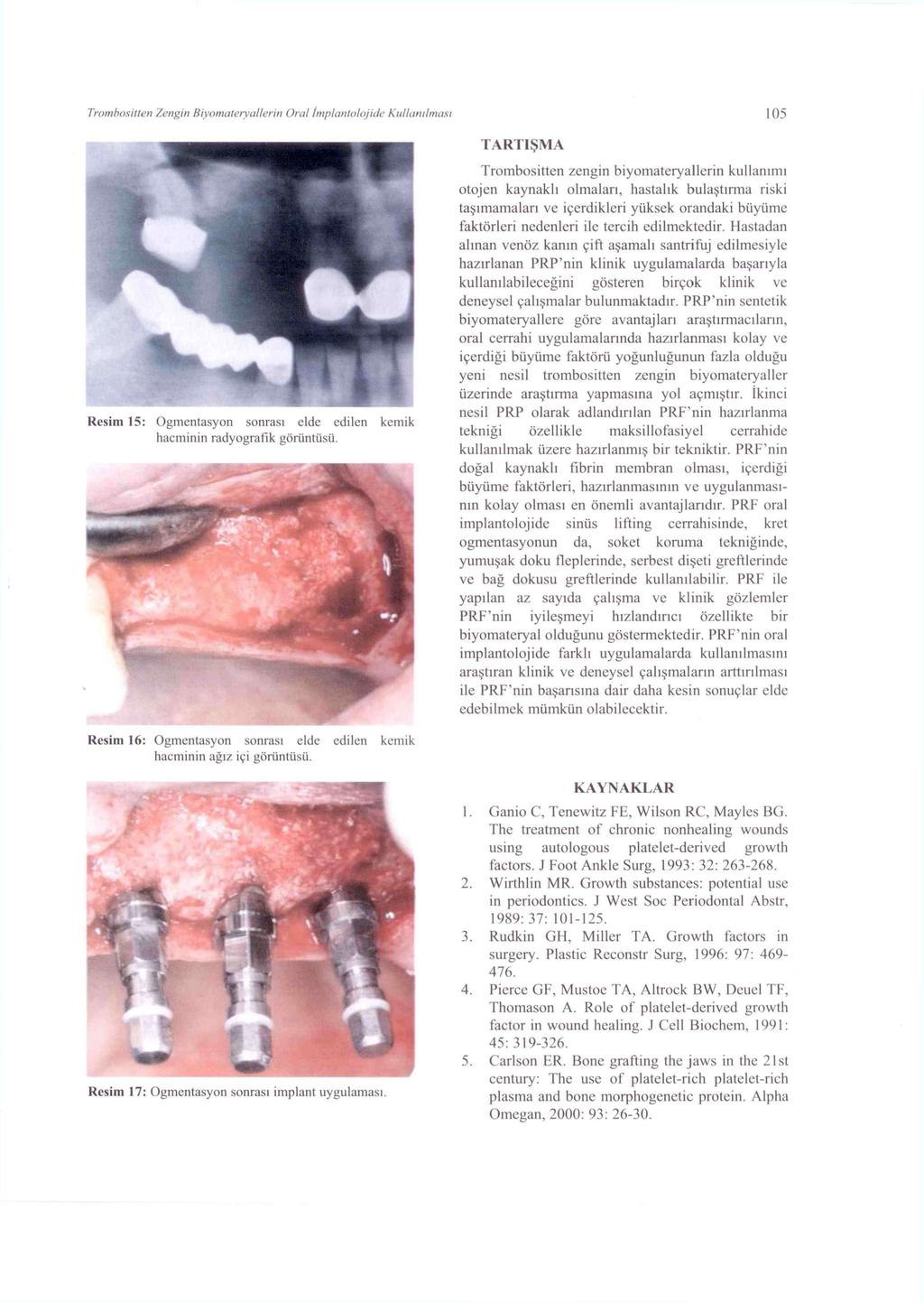 Trombosiilen /.engin Biyomateryallerin Oral tmplantolojide Kullanılması 105 TARTIŞMA Resim 15: Ogmentasyon sonrası elde edilen kemik hacminin radyografik görüntüsü.