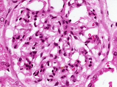 GLOMERULER HASTALIKLARIN Disruption of GBM ETYOLOJĠSĠ Injury to glomerular epithelial cells