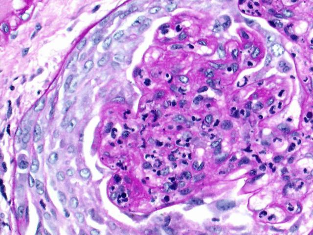 KRESENTĠK GN Synonyms: Incidence: Etiology: Clinical Features: Lab: Path: Clinical Course: Rapidly progressive glomerulonephritis, extracapillary glomerulonephritis. Principally older patients (> 40).