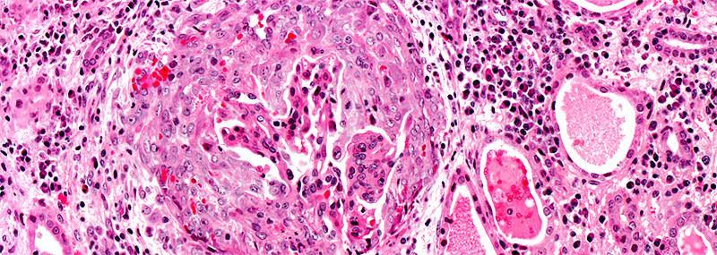 KRESENTĠK GLOMERULONEFRĠT Epithelial cell