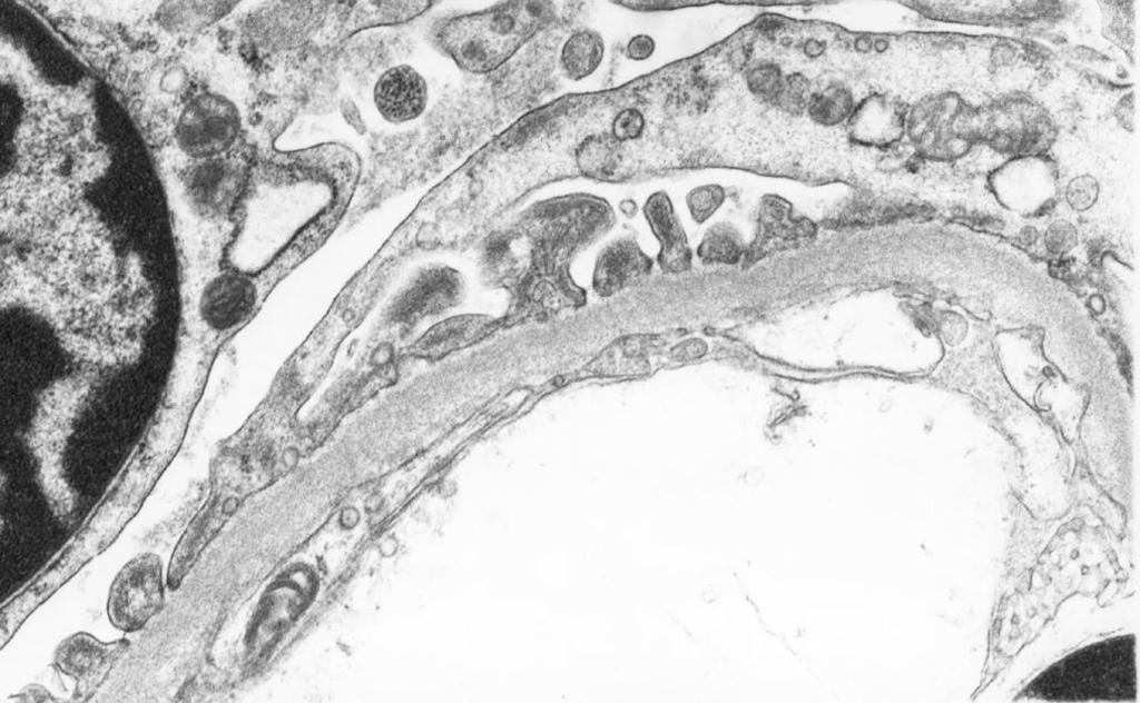 Podositler Glomerular