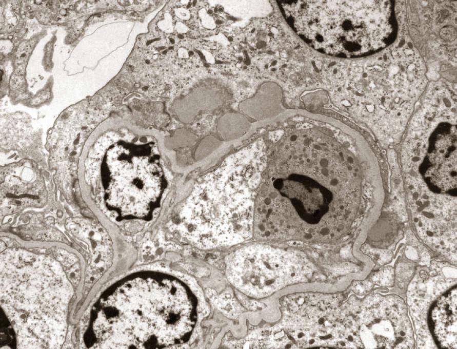 Akut Post-Streptokokkal GN Sinonim: Insidans: Etyoloji: Klinik: Lab: Path: Klinik seyir: Akut proliferatif glomerulonefrit, akut postinfeksiyöz GN. En sık çocuklarda görülür (3-14).