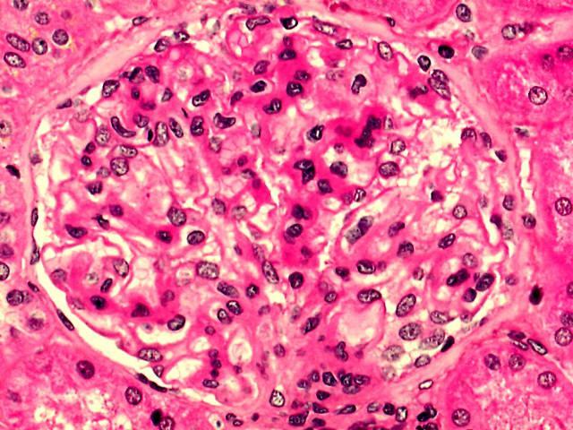 LUPUS NEFRĠTĠ Incidence: Etiology: Clinical Features: Lab: Path: Clinical Course: Sık görülen otoimmun multisistemik hst kadınlarda daha fazla görülür.