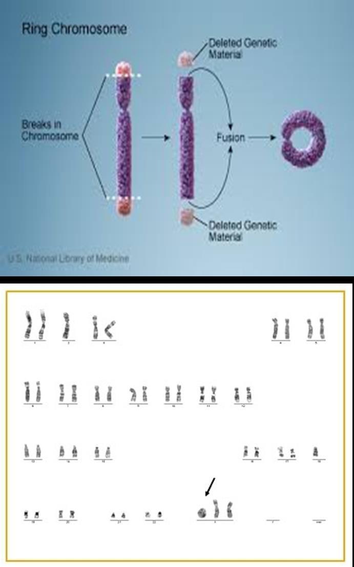 RİNG KROMOZOM Ring (halka) kromozom, bir kromozomda iki kırık uç oluşarak bu uçların halka
