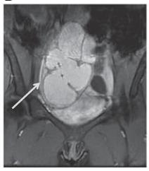 ENDOMETRİOMA 24y, T1- MRI lobulated