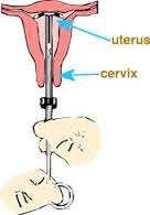 Spekulum uygulanır, vajen ve serviks temizlenir, tenekulum servikse uygulanarak uterus sabitlenir, 6.