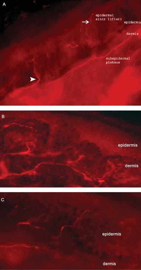 Kurşun O, Karataş H, Uluç K, Early Diagnosis of Distal Peripheral Polyneuropathy Via çal flmalara ra men hastal durdurmaya veya yavafllatmaya yönelik standart bir tedavi yöntemi gelifltirilememifltir.