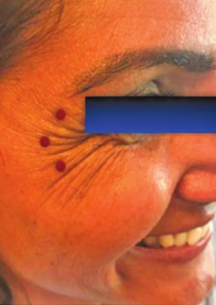 Soldaki resim yukarı bakışta frontal bölge kırışıklıklarıda btx enjeksiyon noktaları, sağdaki resim ise hastanın tedavi sonrası 10. günüdür Burun Sırtı Uygulamaları (Tavşan Çizgileri) M.
