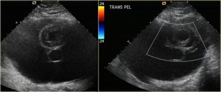 Yeniolgu:Transabdominal USG de sol