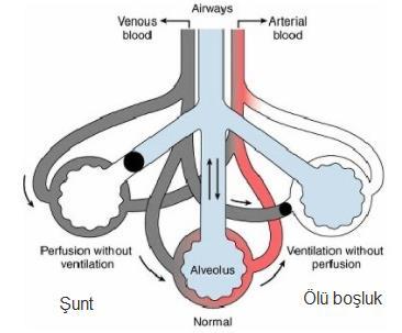 Şant Fizyolojik Pnömoni, atelektazi, kardiyojenik akciğer ödemi, ALI ve ARDS Anatomik ASD,VSD, PDA
