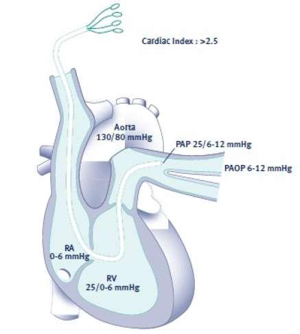 PAK Ölçülen parametreler Pulmoner arter basınçları (PAP, PCWP) Kardiyak output (CO)