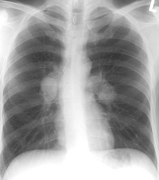 Hastanın PA Akciğer