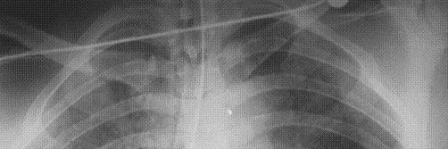 zehirlenmesi) Akciğerlerde oluşan hasar İnhalasyon yanığı sonrası Akciğer grafisi İnhalasyon