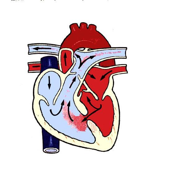 Kalp seslerinin patofizyolojisi AV kapaklarda yetersizlik: Ventriküllerin