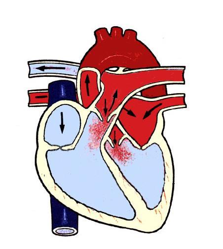Kalp seslerinin patofizyolojisi Sigmoid kapaklarda yetersizlik: Ventriküllerin diastolü