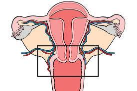 Abdominal radikal trakelektomi