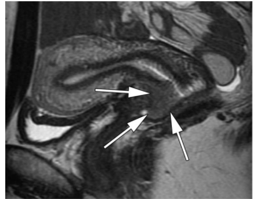 Tümör çapı Preop MRI-Doğruluğu en yüksek inceleme DSİ, tümörün internal osa yakınlığı(1cm) ile ilgili de bilgi verir 4 cm den küçük tümörler en iyi aday 1b2 tümörlerde NACT uygulanabilir, çoğu