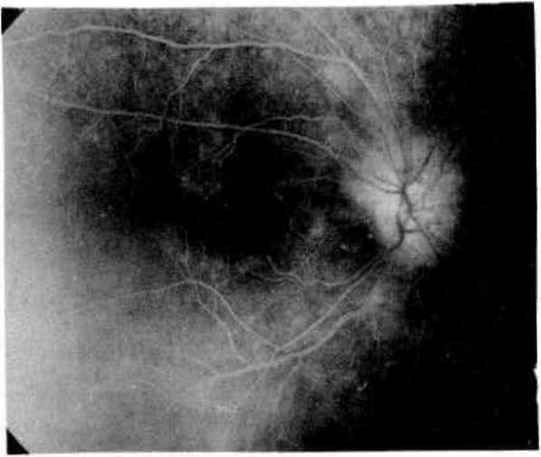 Solda daha fazla olmak üzere papilla temporalindeki atrofinin (Şekil 5-6) ve görme alanı defektlerinin (Şekil 7-8) devam ettiği, retinanın normal görünümünü muhafaza ettiği izlendi.