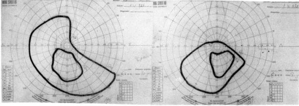 OFTALMOLOJİ AH ALIK 1993 CİLT 2 SAYİ 4 Şekilli. Sağ görme alanı Şekil 12. Sol görme alanı pozitif, sağ-sol lens arka kapsülü ve kodekste başlangıç kesiflikler saptandı.