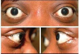 oftalmopati nadir (Goldstein SM et al.