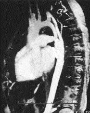 A B Resim 2. A. Distal arkus ve istmusu ilgilendiren uzun segment koarktasyonlu hastada oblik sagital MIP görüntüde conduit ve koarktasyon bölgesi net olarak izlenmekte.