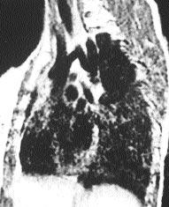 294 Haziran 2002 gösterdi (Resim 3). Koarktasyon şüphesi ile incelenen hastalarda eşleştirilmiş örneklerde t testi ile yap lan değerlendirmelerde ç kan aorta (t=0.16, p=0.88), arkus aorta (t=-0.
