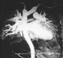 A B Resim 4. A. Çift arkus aortal hastada koronal MIP görüntü sa ve sol arkuslar net olarak ortaya koymakta. B. Oblik aksiyal MIP görüntüde inferior bak flta sa da devams zl k da izlenmekte.