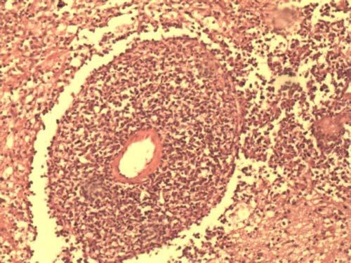 Resim 4: Kan damarlarına ve perivasküler boşluklara invazyon gösteren tümör hücreleri (Hematoksilen-eosin X 200). TARTIŞMA PSSSL'sı tüm lenfomaların %1 ini oluşturur.