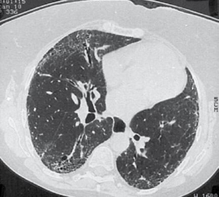 Sarı RA. 361 a Şekil 2. RA da obliteratif bronşiolitis ve akciğer fibrozisi. b Şekil 3. HRCT; Bilateral alt zonlarda mikroskopik bal peteği görünümü (SSk).
