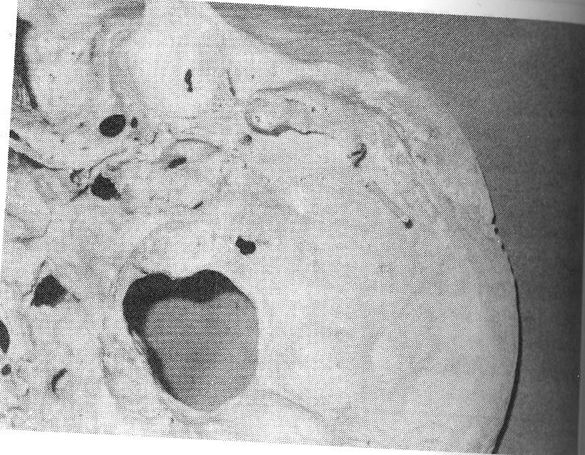 Göztepe T p Dergisi 18: 77-81, 2003 BULGULAR 464 temporal kemik içinde 104 ünde (% 22.41) for. mastoideum gözlenmedi (fiekil 1).