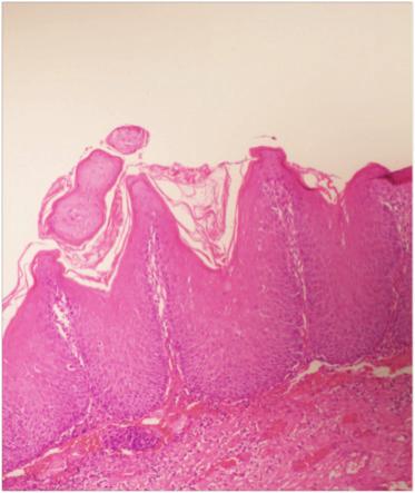 52 Oral Lökoplakinin Malign Transformasyonu: Olgu Sunumu Şekil 3. Lökoplakinin olduğu bölgede yüzeyi ülsere görünümlü lezyon. Şekil 2.