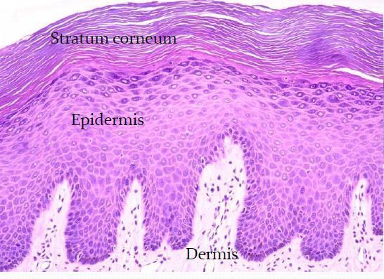 Tanı Biopsi Histopatoloji Epidermiste incelme Subepidermal