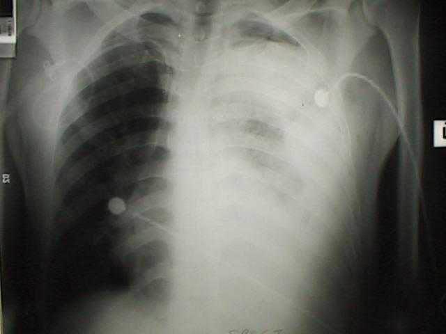 yetmezliği Akciğer grafisi CT Aşırı sıvı