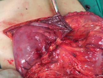 Karın içi kirli ve kontaminasyon varsa stamm gastrostomi yapılmalıdır. Resim 13. Mide büyük kurvaturda perforasyon Duodenum yaralanmaları genellikle pankreas yaralanmasıyla beraberdir.