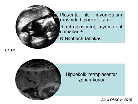 Op sırasında plasentanın perkreata + ve plasenta alınabildiği kadarı ile çıkarılıp kürete edilip, uterus kapatılmıştır.